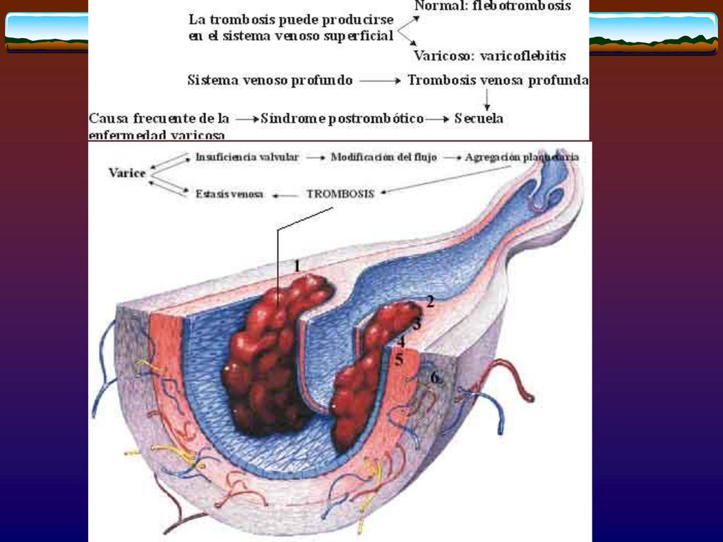 incompetencia valvular del sistema venoso superficial bilateral